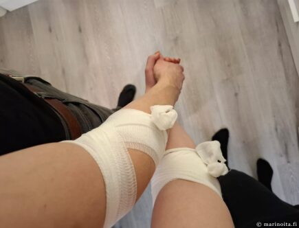 Kaksi sideharsoon käärittyä kättä käsikädessä verenluovutuksen jälkeen.